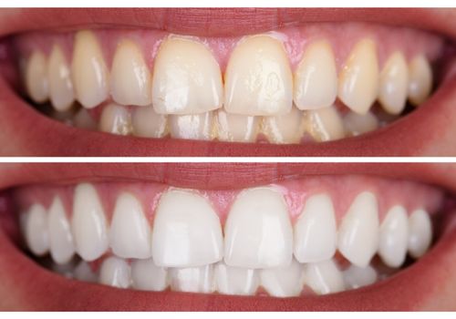 braces-sebelum-selepas-1.jpg