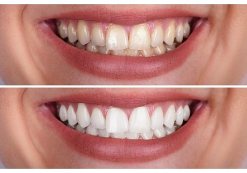 braces-sebelum-selepas-2.jpg