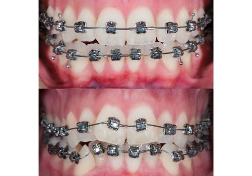 braces-sebelum-selepas-3.jpg