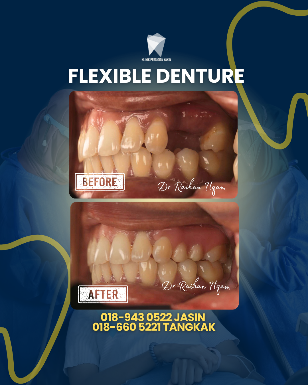 FLEXIBLE DENTURE