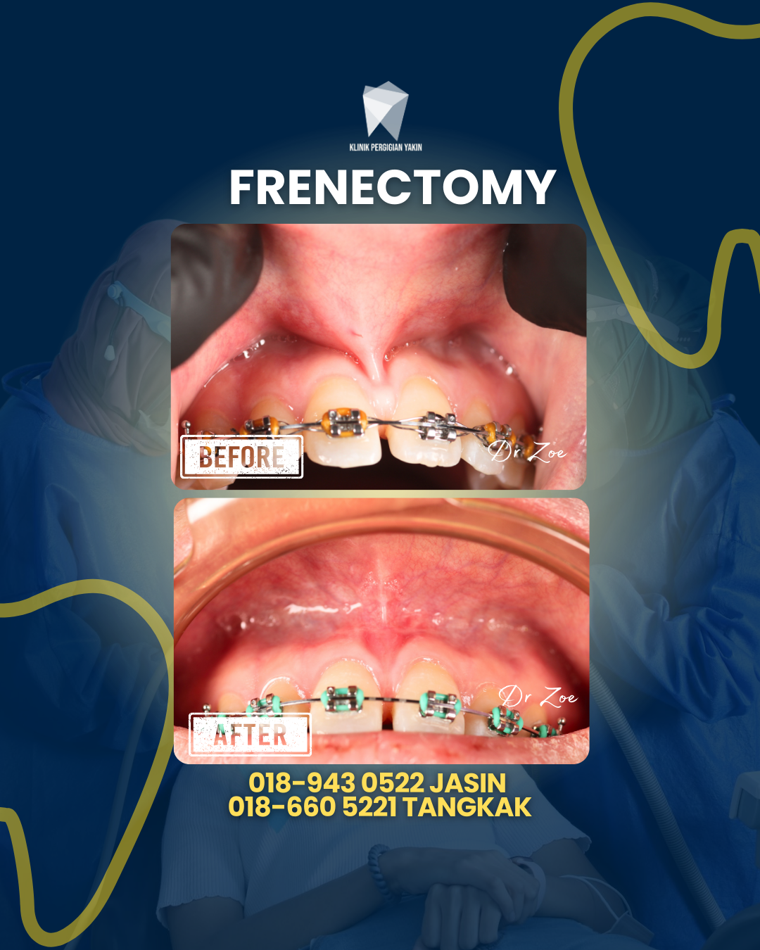 FRENECTOMY
