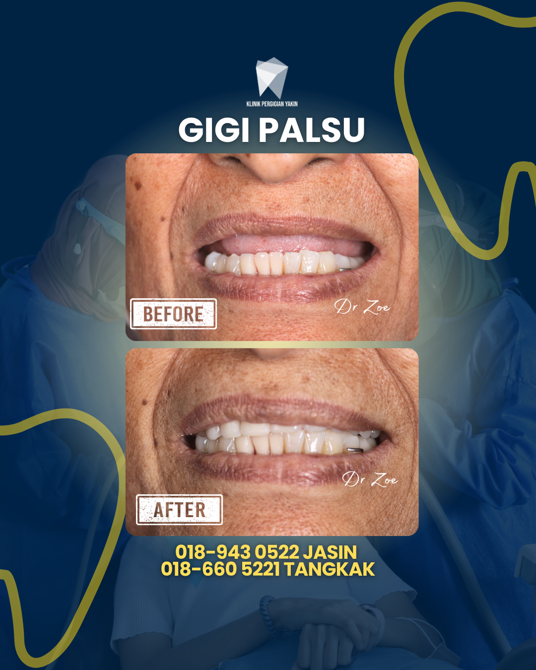 GIGI PALSU (2)