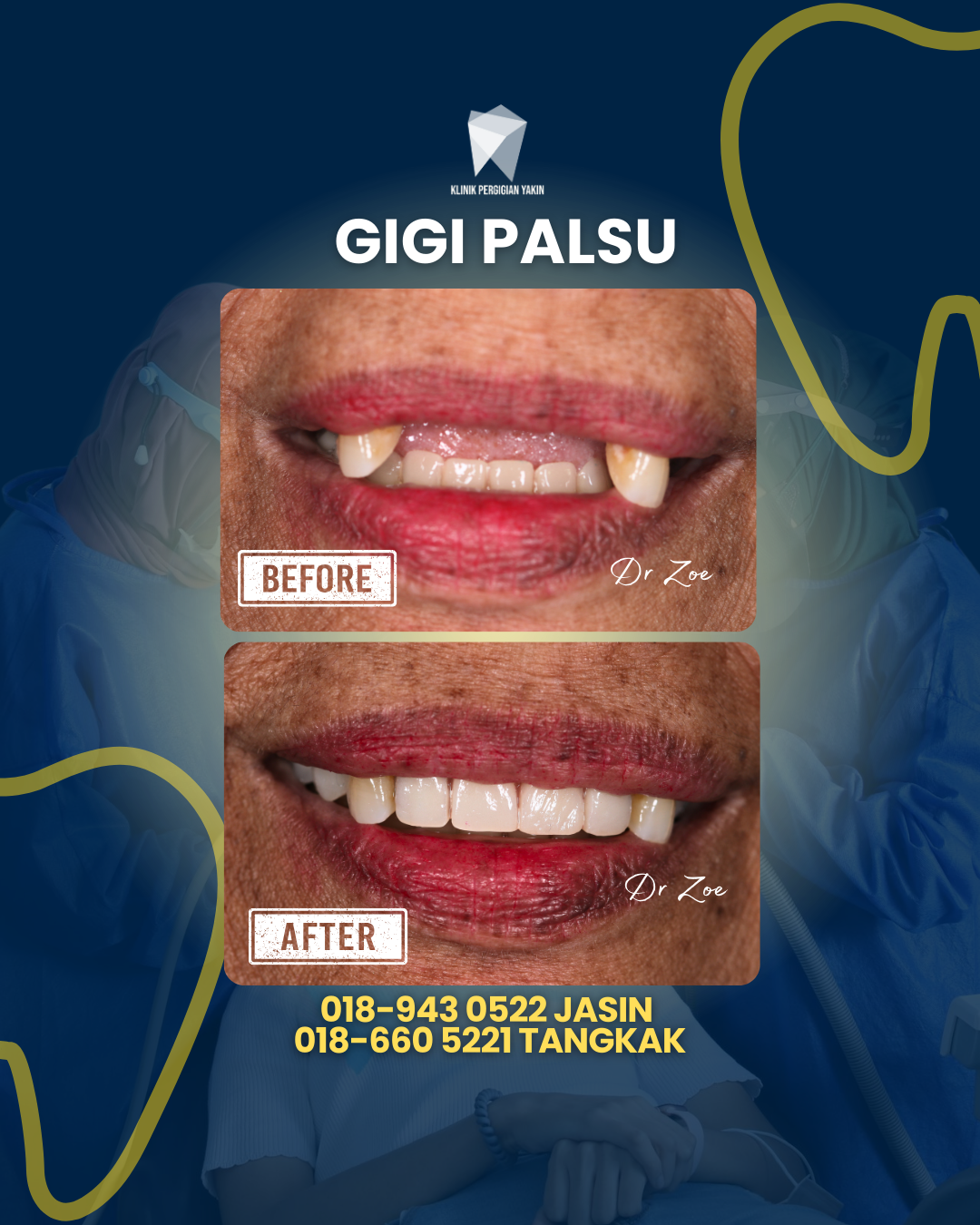GIGI PALSU