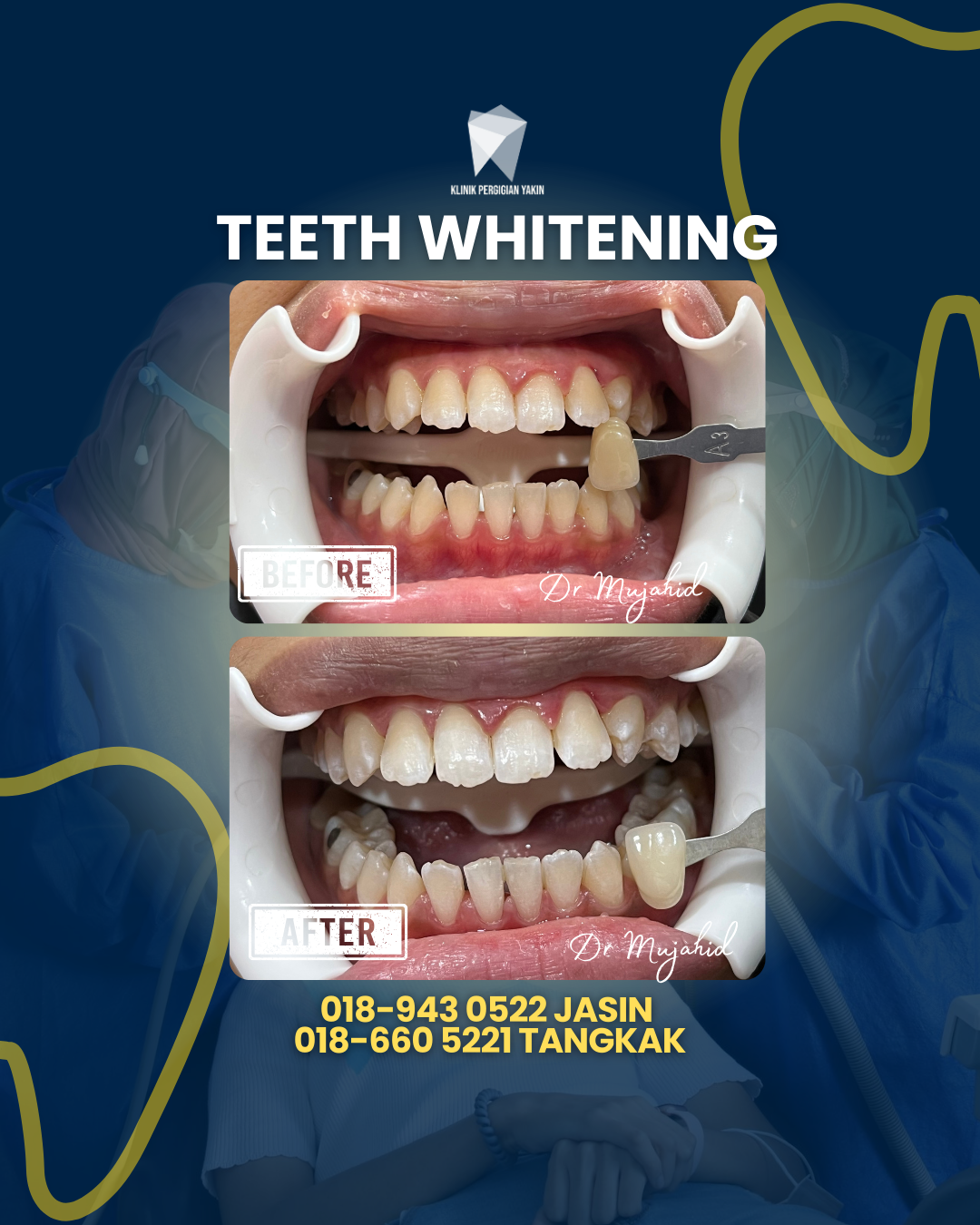 TEETH WHITENING (2)
