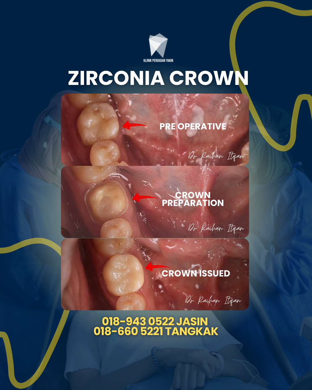 ZIRCONIA CROWN (2)