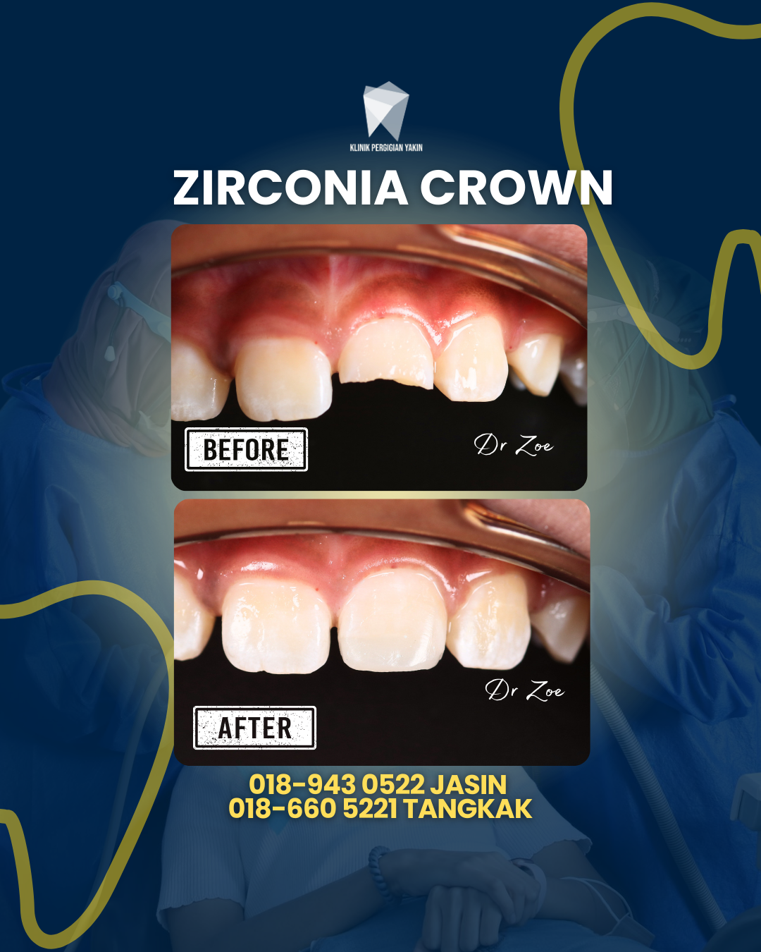 ZIRCONIA CROWN